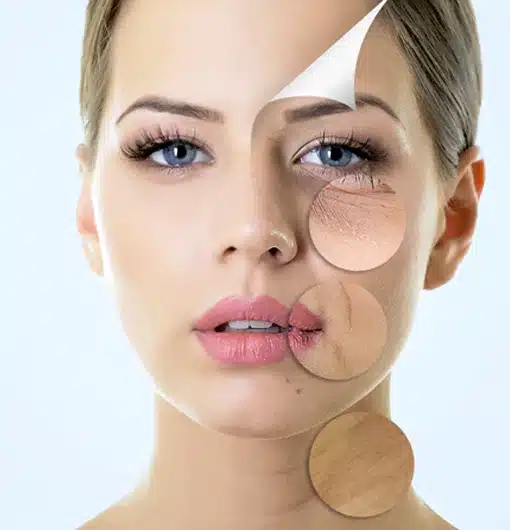 Facial volume treatment