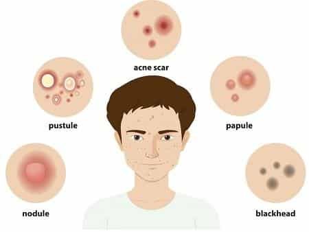 Acne is a common inflammatory dermatological skin condition that causes spots and pimples, especially on the face, neck...