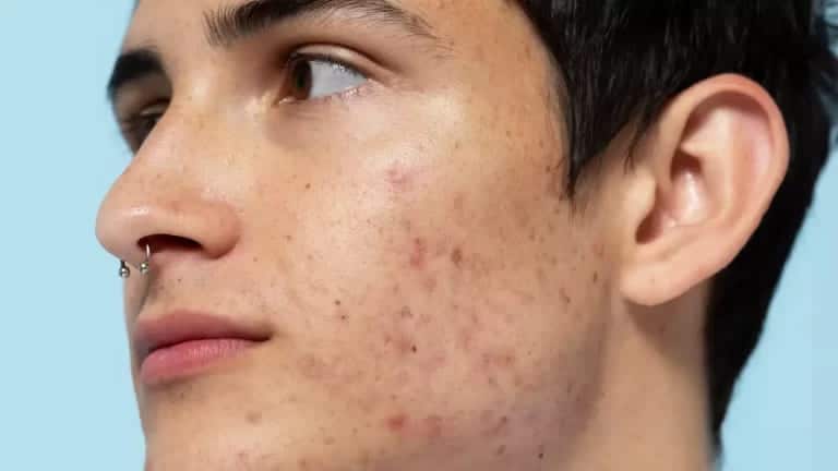 Acne, commonly called as pimples, can be very distressing posing cosmetic and psychological concerns. Acne can be caused...