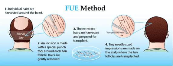 Follicular Unit Extraction [FUE]  Hair Transplant is a popular hair restoration surgery that is minimally invasive...