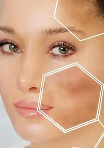 Melasma