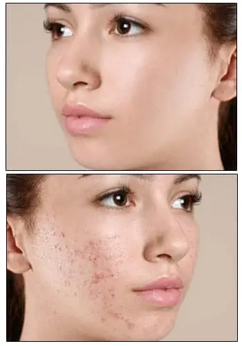acne treatment