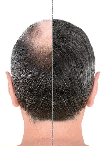 hair transplant