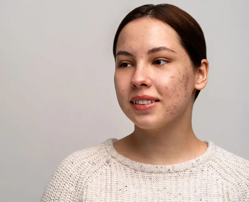 Adult Acne Treatment in Hyderabad