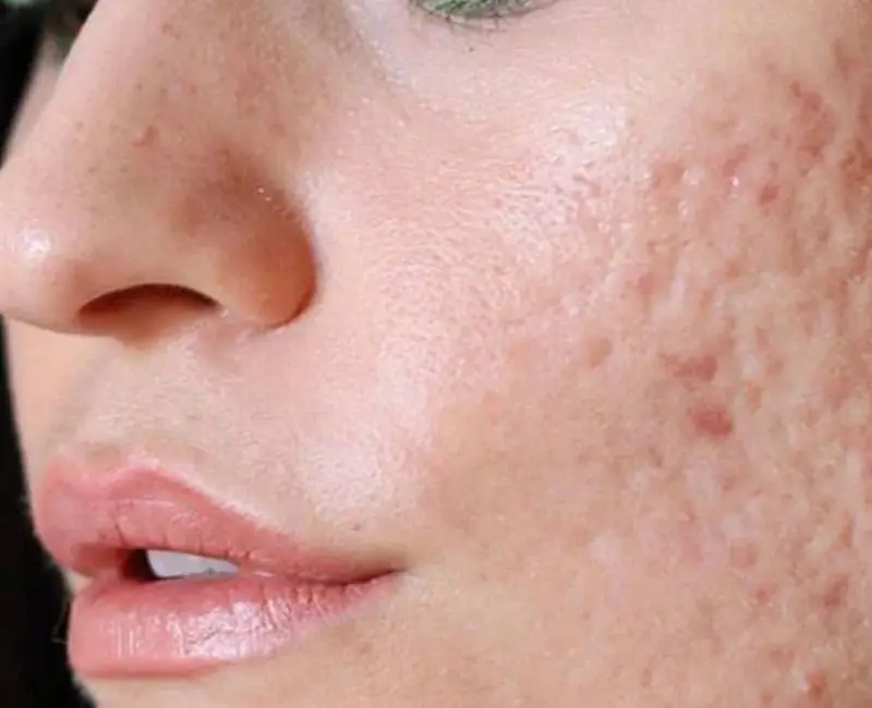 Deep Scars Treatment