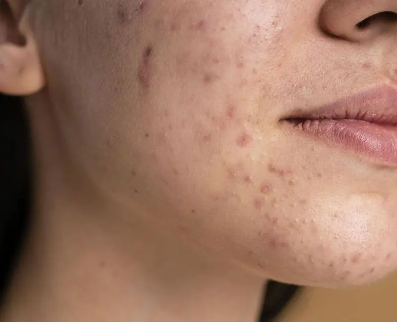 PCOS Related Acne