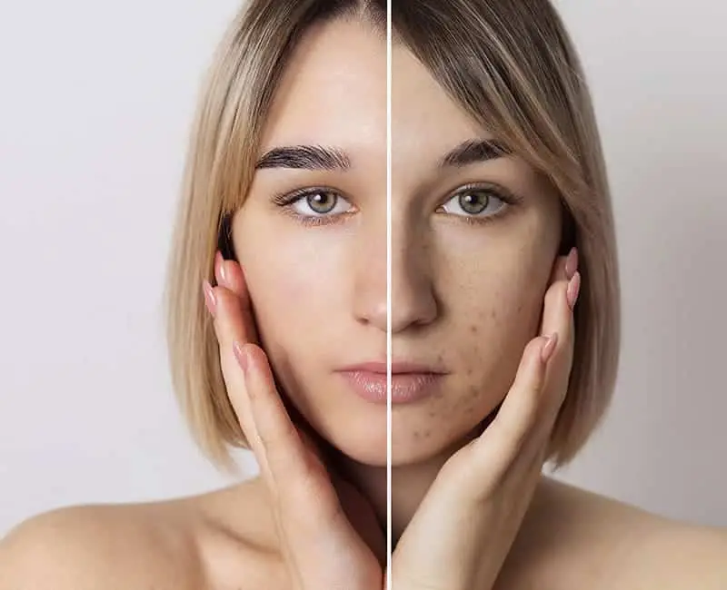 Pimple Marks Treatment in Hyderabad