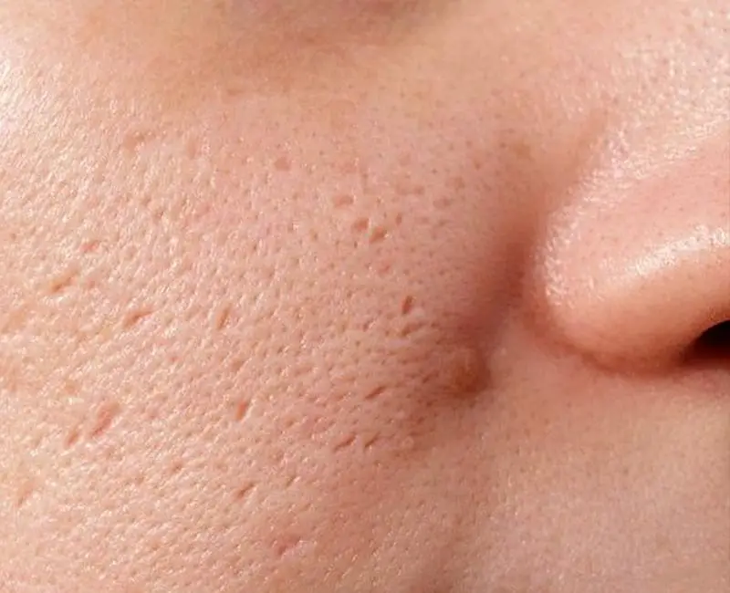 Ice Pick Scars Treatment