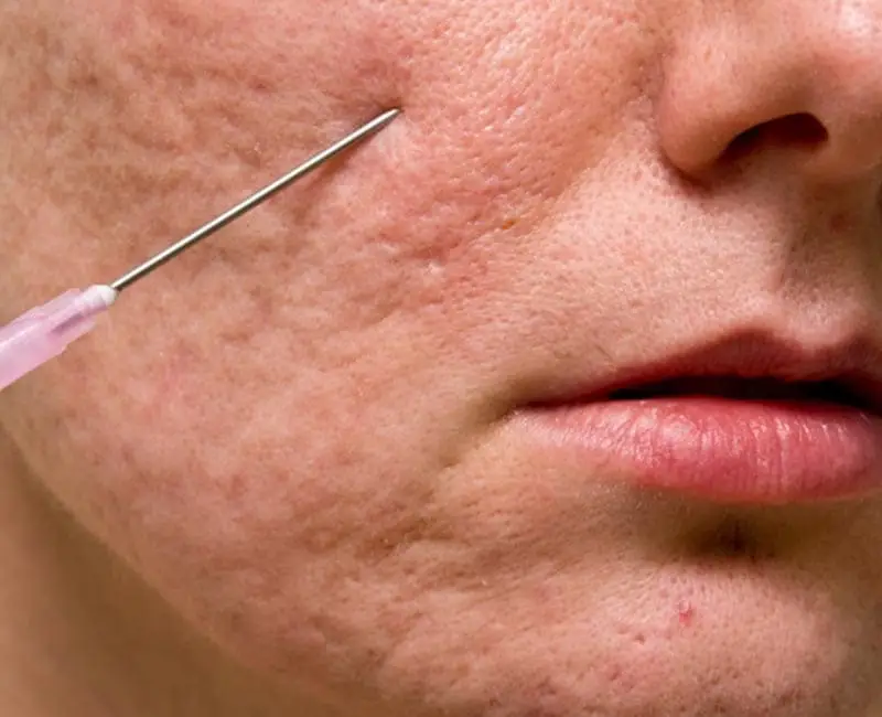 Pitted Acne Scars