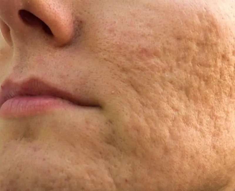 Rolling Acne Scars Treatment