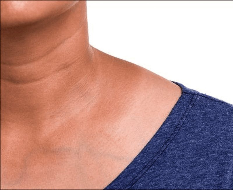 Acanthosis Nigricans