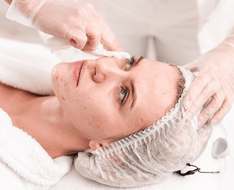 Acne Facial Treatment
