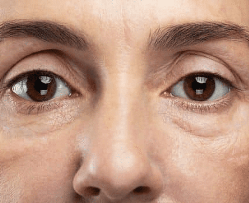 Eye Hollowness