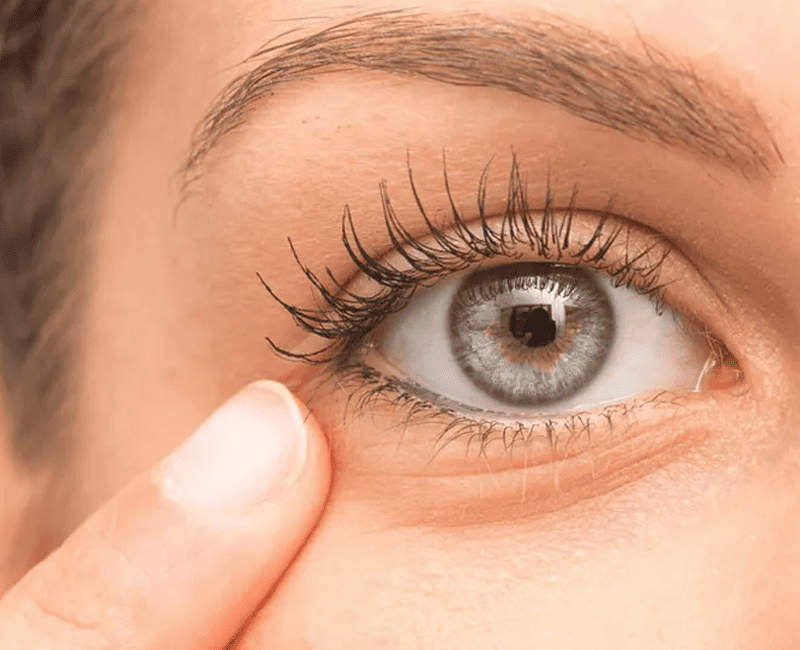 Eye Wrinkles Treatment