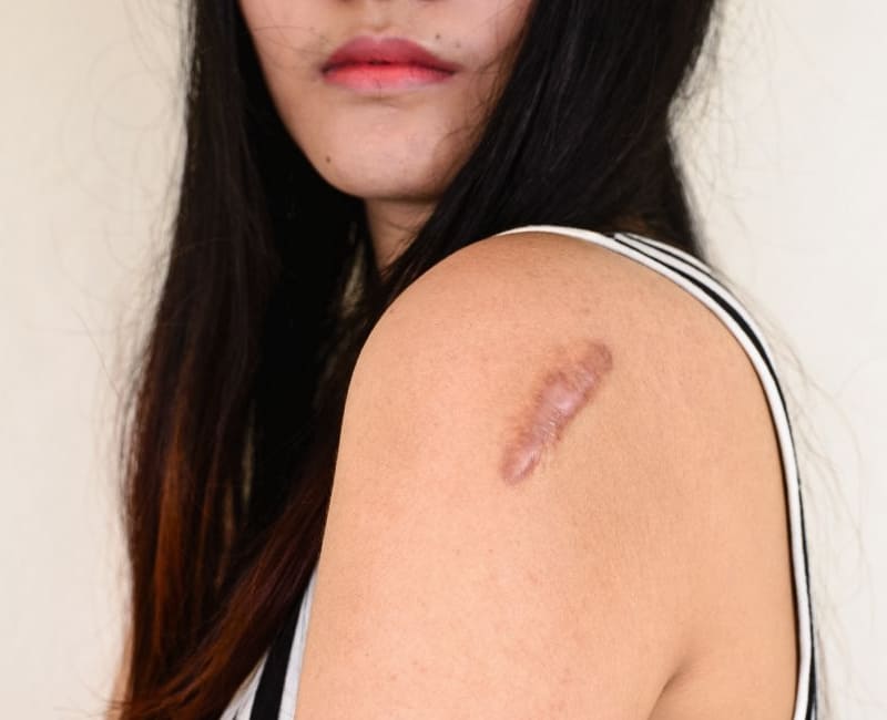 Keloid Scars