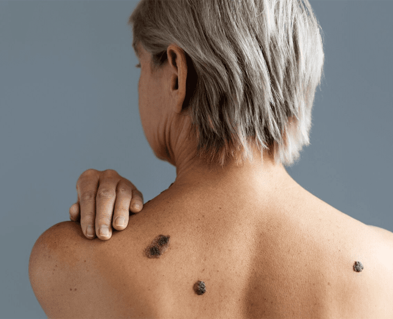 Maturity Melanosis Causes Symptoms Pigmentation Treatment FMS 