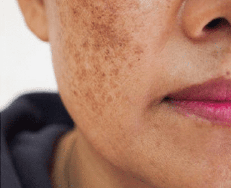 Skin Melanosis Treatment