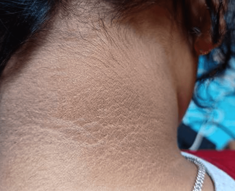 Acanthosis Nigricans Causes Symptoms Pigmentation Treatment FMS 