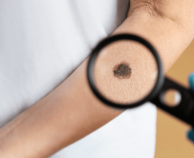 Treatment for Maturity Melanosis