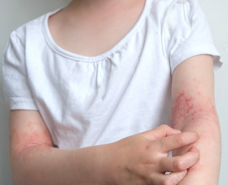 CHILD PSORIASIS