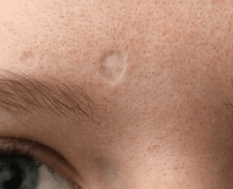 Chickenpox Scars