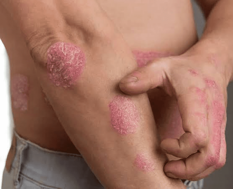 Chronic Psoriasis Treatment