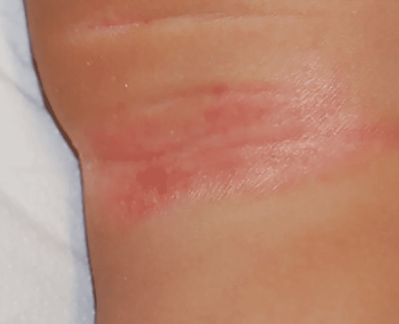 Flexural Psoriasis