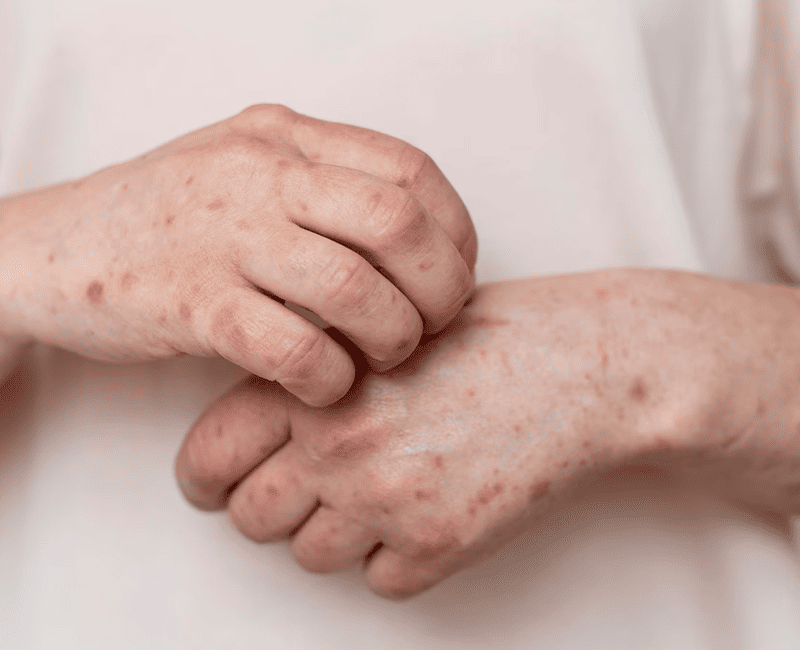 Guttate Psoriasis