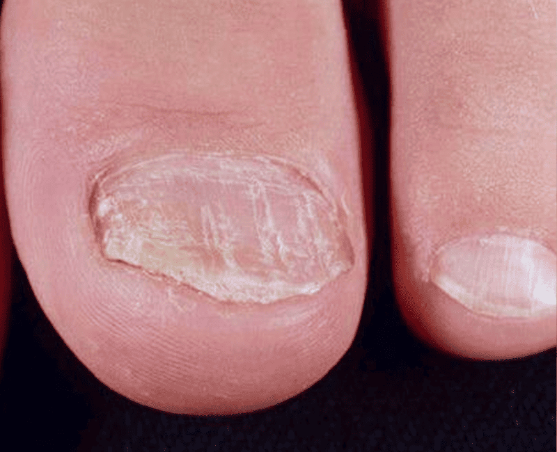 Nail Psoriasis