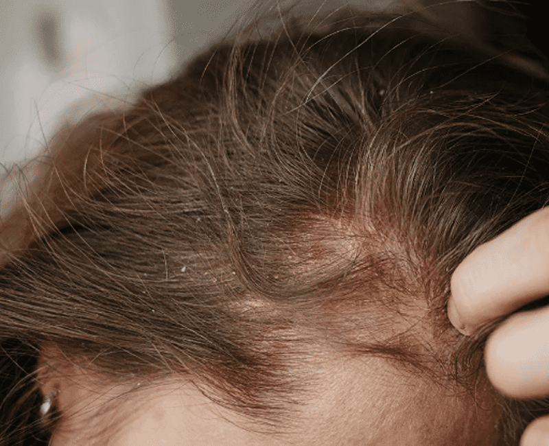 Scalp Psoriasis