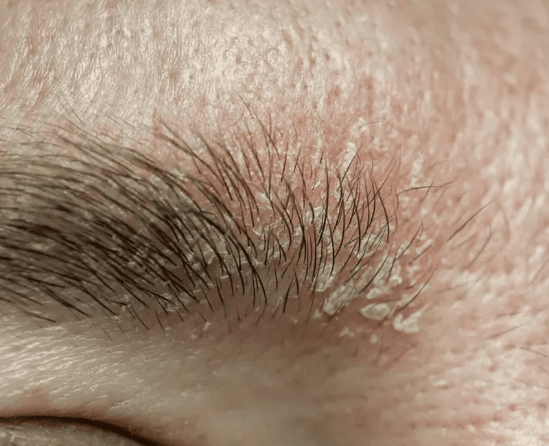 Sebopsoriasis