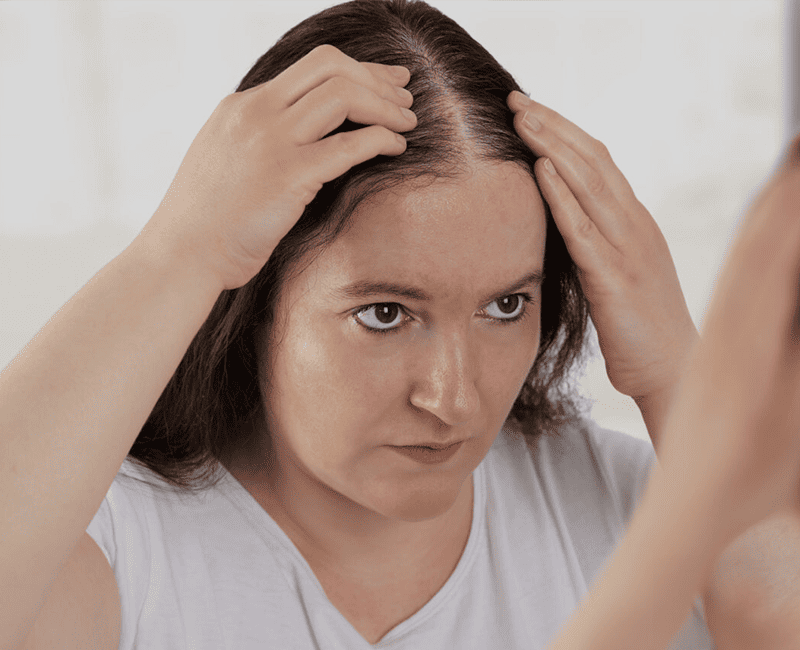 Chronic Telogen Effluvium