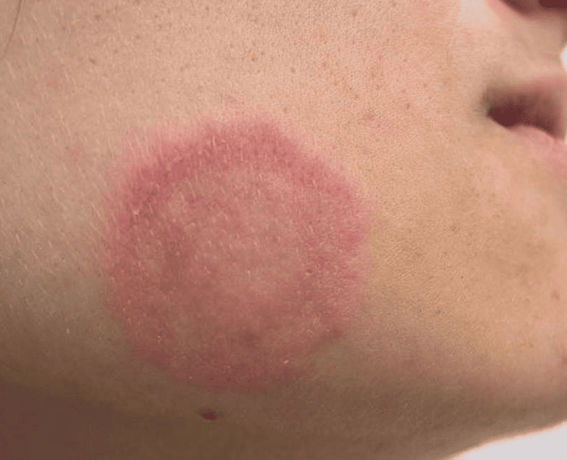 Facial Fungal infection