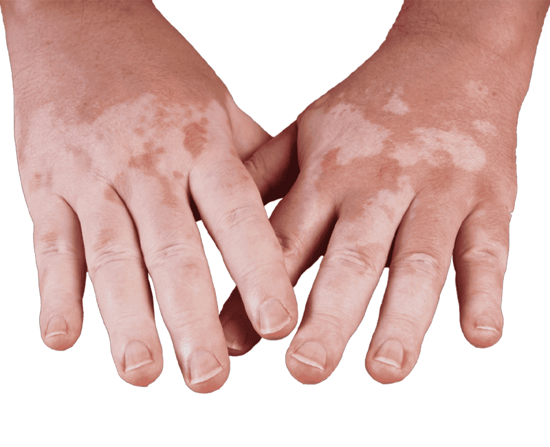 Childhood Vitiligo Treatment