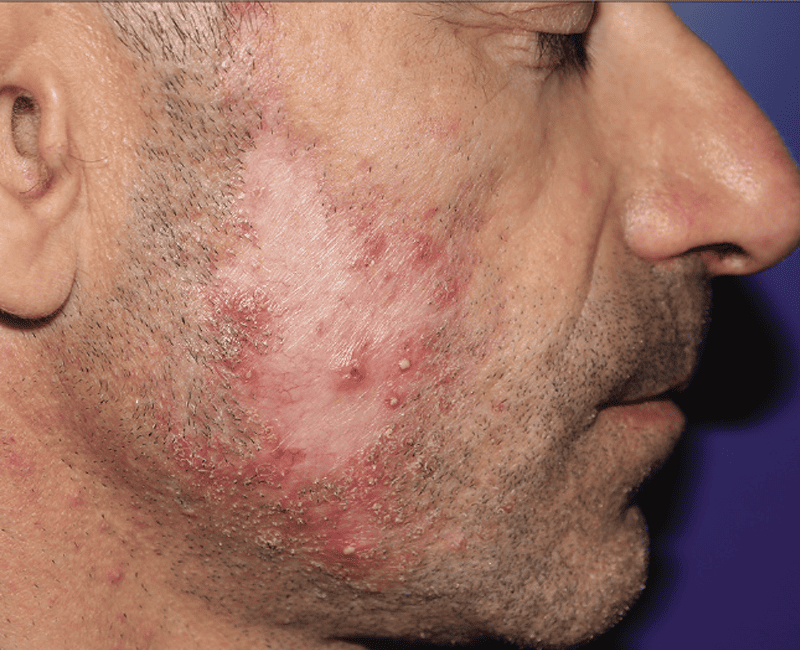 Beard Infection