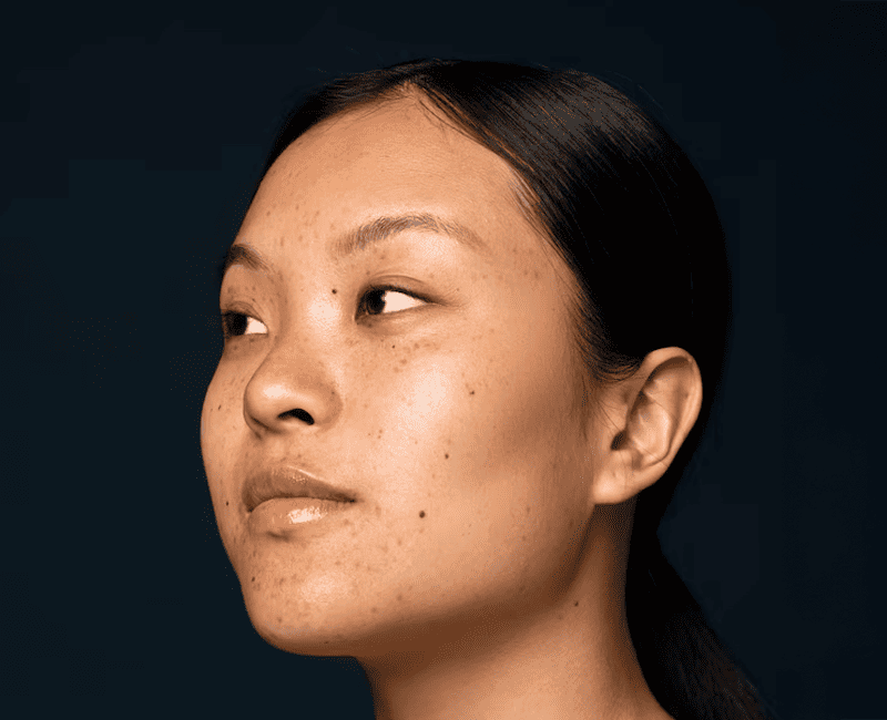 Dermatosis Papulosa Nigra (DPN)