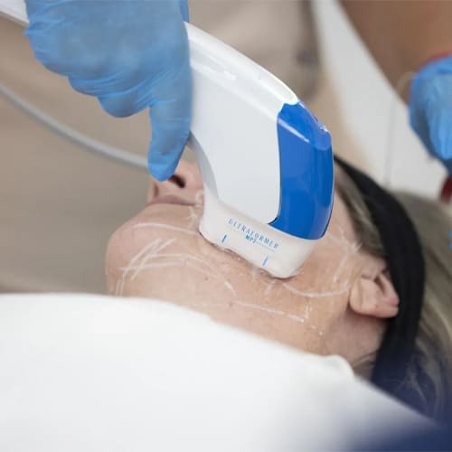 HIFU Treatment in Hyderabad