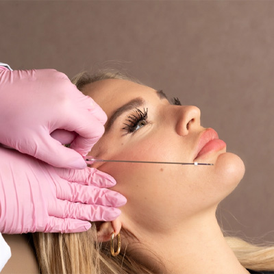 Thread Lift Procedures