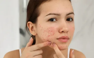 Acne and acne scar treatment in Hyderabad