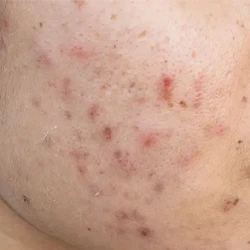 Adult acne after teenage years