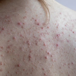 Back and body acne on shoulders and back