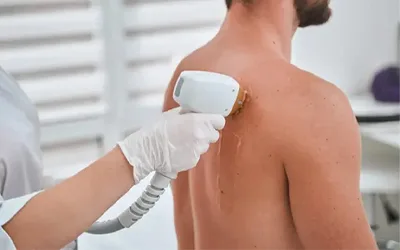 Full and half back laser hair removal