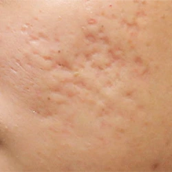 Boxcar acne scars