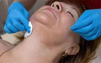 Chemical Peel and Glutathione IV for Neck Treatment