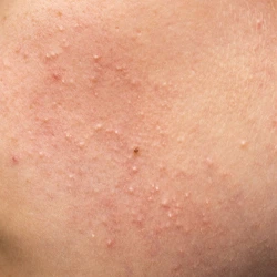 Comedonal acne with whiteheads and blackheads