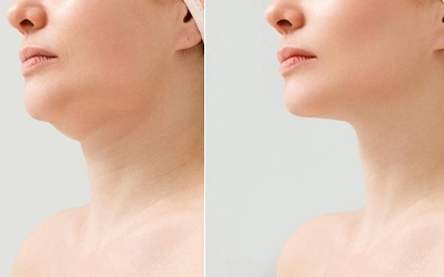 Double chin treatment