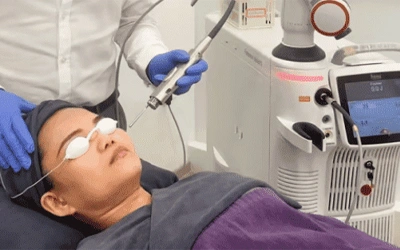 Fotona Laser for Solar Lentigines Treatment