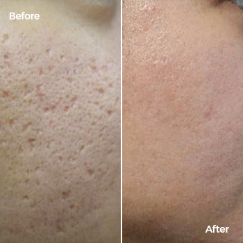 Fractional laser and MNRF treatment for boxcar scars before and after
