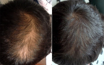 Hair loss Treatment