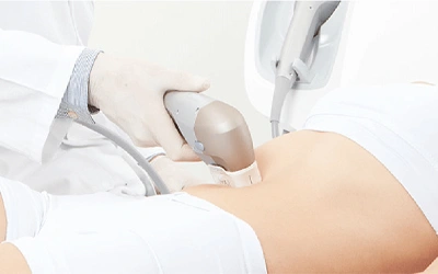 HIFU Ultraformer body treatment